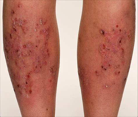 what is epidermolysis bullosa eb.